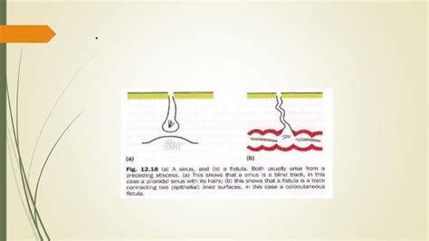 Sinus and fistula