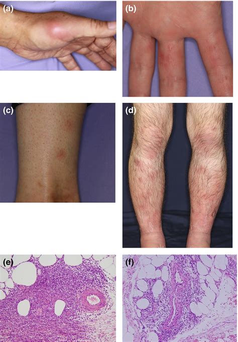 Guidelines for the treatment of skin and mucosal lesions in Behçet's ...