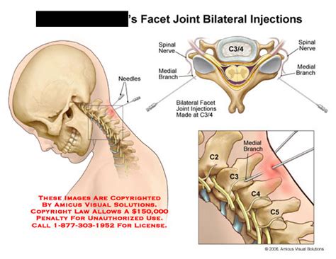 AMICUS Illustration of amicus,surgery,cervical,facet,joint,injection,bilateral,C3-4,needle,nerve ...