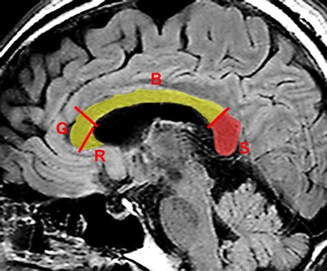 Reversible lesion in the splenium of the corpus callosum - Tetsuka - 2019 - Brain and Behavior ...