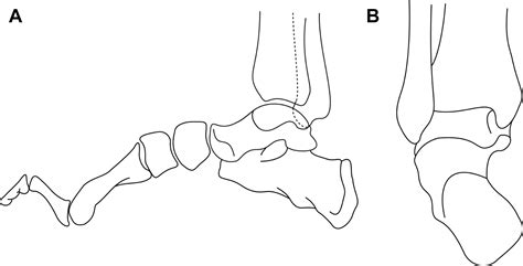 Anatomy and Biomechanics of Cavovarus Deformity - Foot and Ankle Clinics