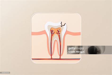 Tooth Decay Cross Section Anatomy Paper Cut Craft High-Res Stock Photo - Getty Images