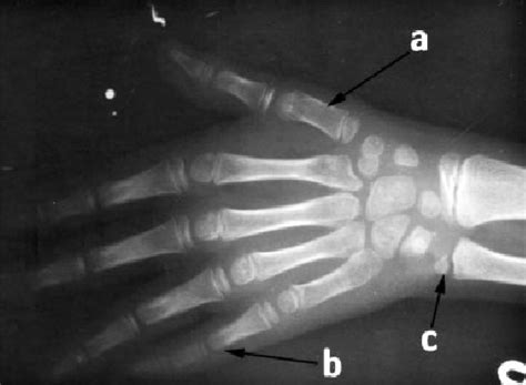 Hand and wrist x-ray showing (a) short first metacarpal, (b ...