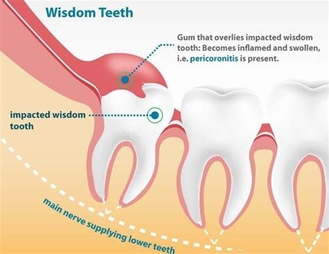 Pericoronitis - causes, symptoms and treatment | News | Dentagama