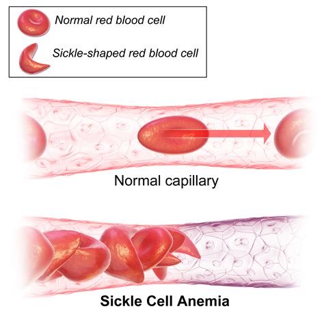 CRISPR gene editing corrects sickle cells in a mouse | NextBigFuture.com