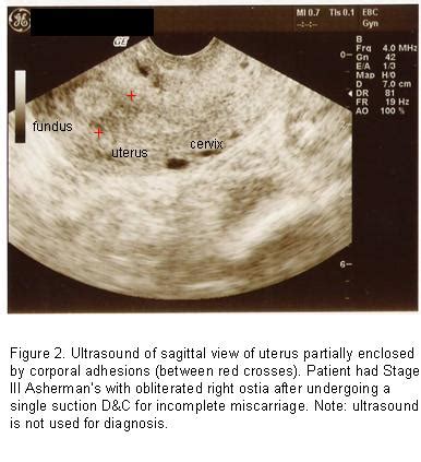 Asherman's syndrome ultrasound - wikidoc