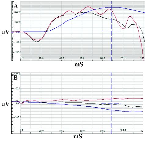 Electroretinography results of case 1 with normal traces of rod (blue)... | Download Scientific ...