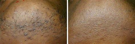 Laser Hair Removal Photos | Houston, Tx | Patient 8039