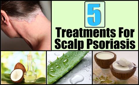 TOP 5 TREATMENTS FOR SCALP PSORIASIS ~ Mzizi Mkavu