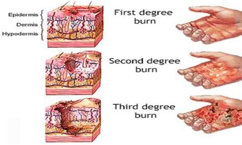 Burn Scars Problem: How to Deal with a 28 year Third Degree Burn Scar ...