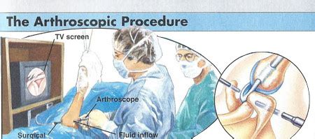 Dr. John Skedros | Dr. Skedros Arthroscopic diagram