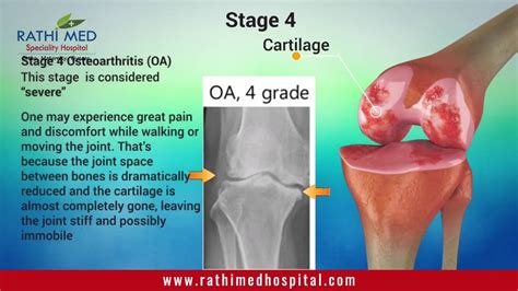 Osteoarthritis - An Introduction | Joint Pain Causes | Stages Of Osteoarthritis of the knee ...