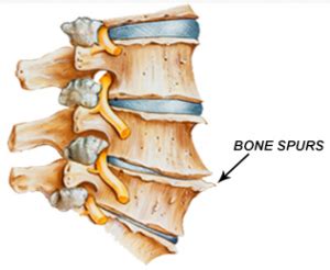 Cervical Bone Spurs - Cervical Osteophytes - Neck Pain