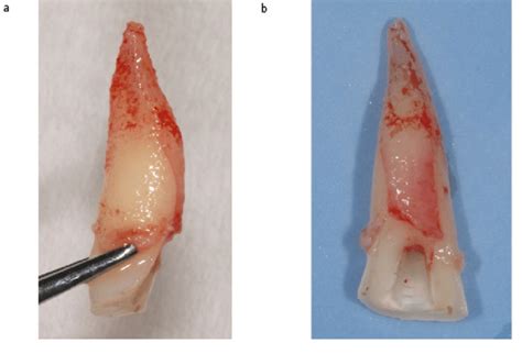 Upper central incisor with clinically diagnosed crown fracture. The... | Download Scientific Diagram