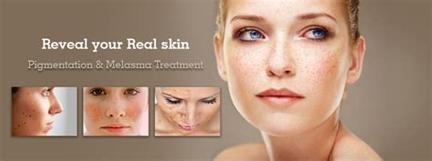 Pigmentation & Melasma Treatment in Pune – Skin Pigmentation on Face