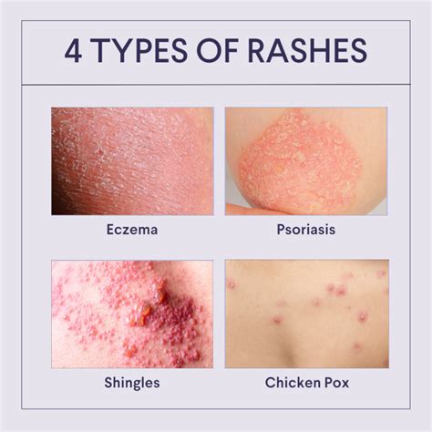 Common Causes of Rashes, a rash - mi-pro.co.uk