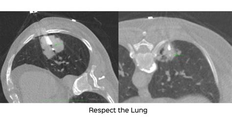 Lung Nodule Biopsy Procedure