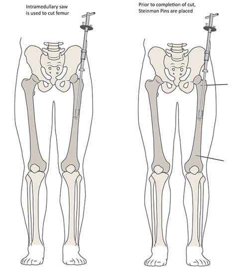 Fem Intramedullary Nail Surgical Technique - Nail Ftempo