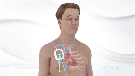 Tunneled Catheter Placement Video | Medical Video Library