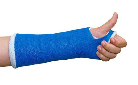 Broken Hand Cast Stock Photos, Pictures & Royalty-Free Images - iStock