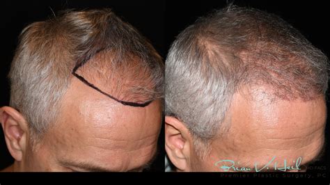 Hair Restoration Before and After | Premier Plastic Surgery