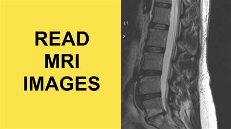 Lumbar Spine Mri Bulging Disc