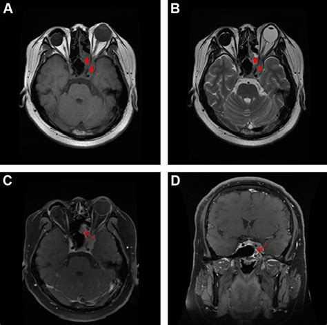 Magnetic resonance images of the cavernous sinus. Notes: axial T1 ...