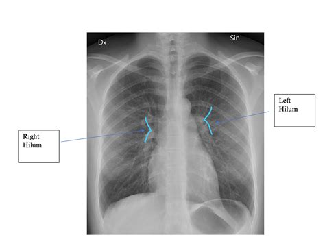 Hilum of the Lung | Geeky Medics