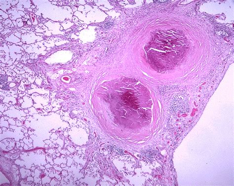 Histoplasmosis | Netherlands| PDF | PPT| Case Reports | Symptoms | Treatment