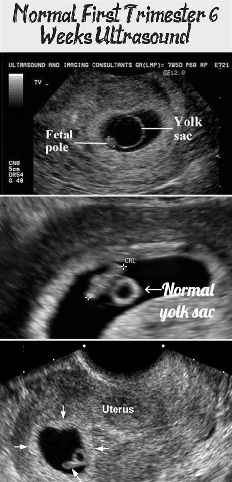 Normal first trimester 6 weeks ultrasound. - Ultrasoundfeminsider # ...