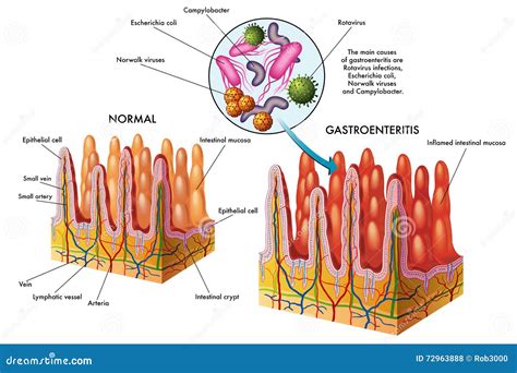 Gastroenteritis Vector Illustration | CartoonDealer.com #72963888