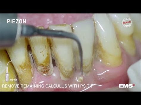 Guided Biofilm Therapy Step 06: Calculus removal with PIEZON® and the PS instrument - Dental Clinic