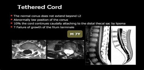 17 Best images about tethered spinal cord on Pinterest | Physical ...