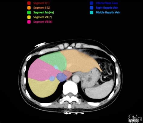 Couinaud classification of hepatic segments | Radiology Reference ...