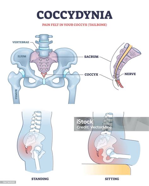 Coccydynia As Pain Felt In Coccyx Or Tailbone Anatomical Outline Diagram Stock Illustration ...