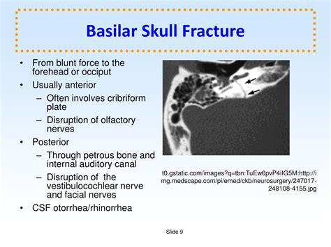 Basilar Skull Fracture Signs