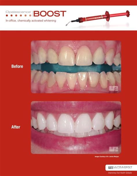 Teeth Whitening - Renaissance Dental Studio