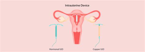 IUD Birth Control: Effectiveness & Side Effects - All You Need to Know