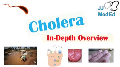 Cholera (Vibrio Cholerae) Pathophysiology, Risk Factors, Symptoms, Diagnosis, and Treatment ...