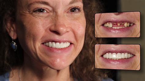 Press on veneers by brighter image lab. This client is an amazing lady ...