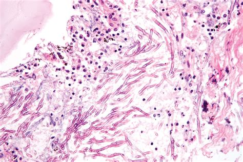 Mycosis | Causes, Symptoms, & Treatment | Britannica