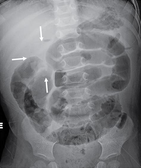 Screaming fits: Intussusception | Radiology Key