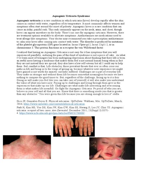 Aquagenic Urticaria Syndrome 24 | PDF | Clinical Medicine | Diseases ...