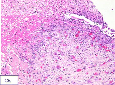 Renal Papillary Necrosis Caused by Protein C Deficiency Leading to Recurrent Hydronephrosis ...