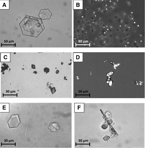 Crystals in urine cause, what does it mean to have crystals in urine