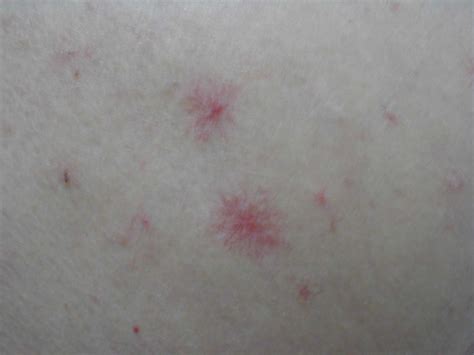 Spider angioma - wikidoc