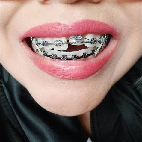 #braces #girlswithbraces #metalbraces #elastics #powerchain #springs ...