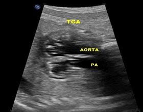 Fetal Echocardiogram in Delhi