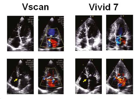 Ostium primum atrial septal defect with cleft mitral valve may (bottom ...