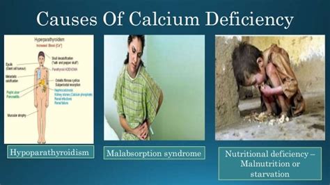 Common Causes And Symptoms Of Calcium Deficiency